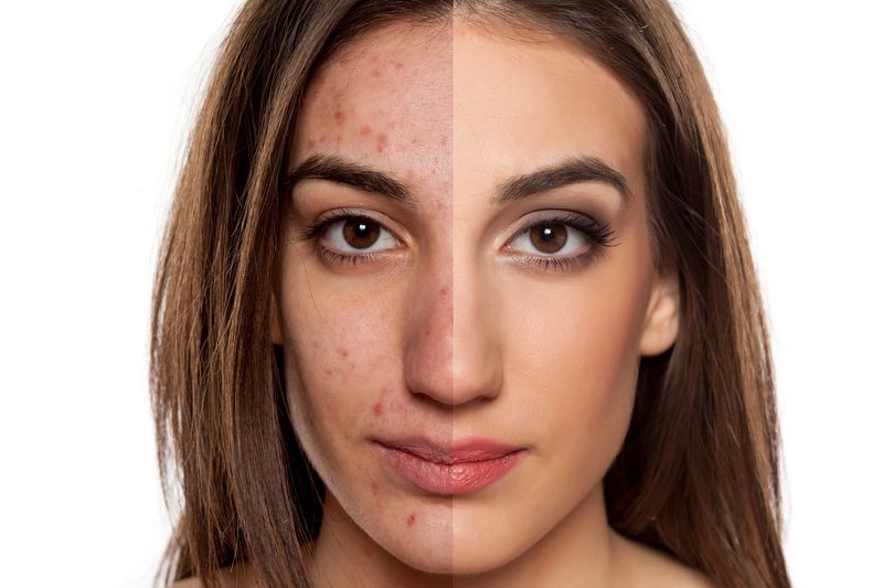 acne and acne scarring treatment