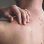 Does skin cancer itch?