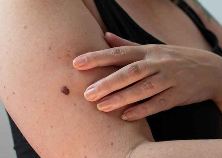 where does early skin cancer appear