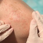 Spotting the Most Common Pre-Cancer Sign -Actinic Keratosis